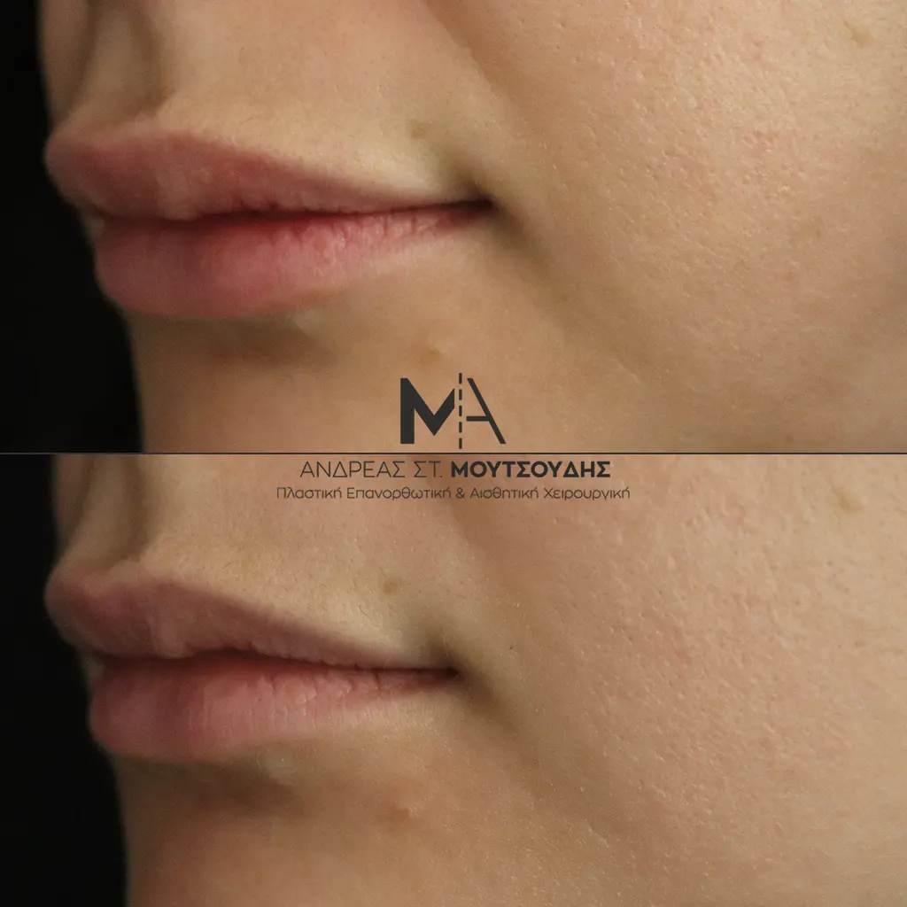 Υαλουρονικό Οξύ μέσα από αληθινές φωτογραφίες Πριν και Μετά