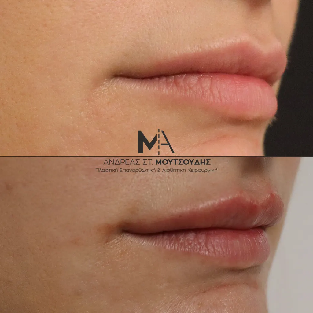 Υαλουρονικό Οξύ χείλη (δεξιά) αληθινές φωτογραφίες Πριν και Μετά