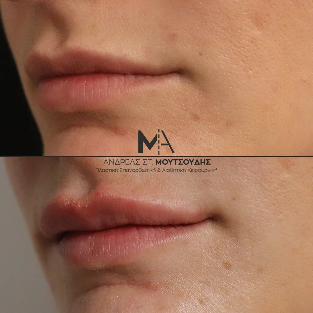 Υαλουρονικό Οξύ χείλη (αριστερά) αληθινές φωτογραφίες Πριν και Μετά