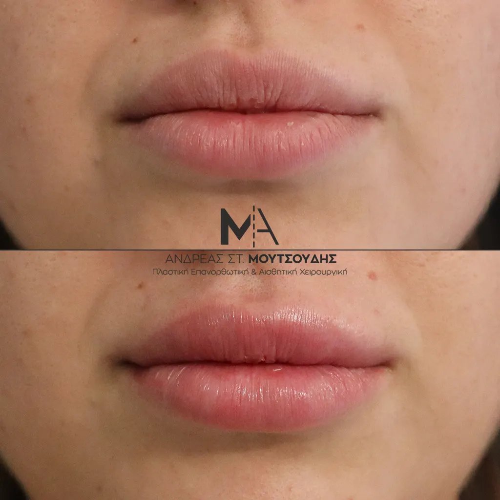 Υαλουρονικό Οξύ χείλη φωτογραφίες Πριν και Μετά
