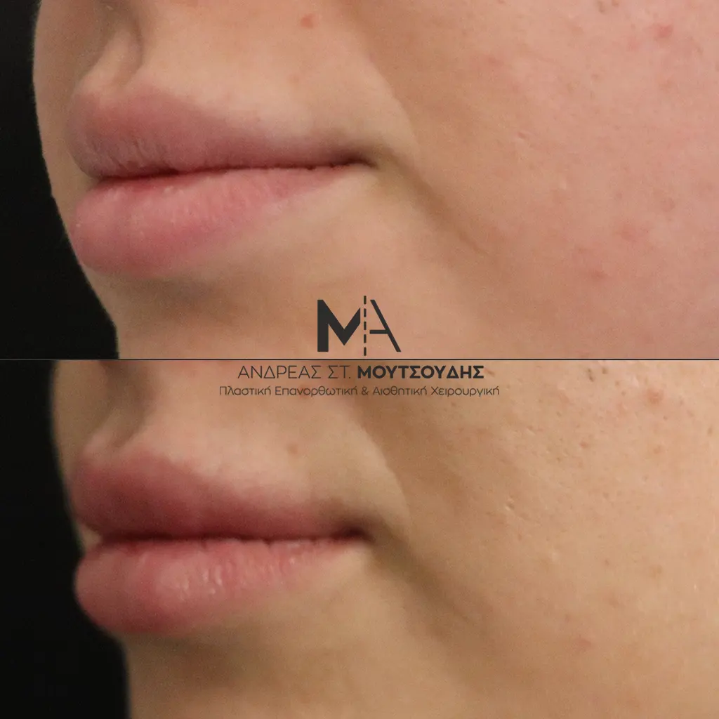 Υαλουρονικό Οξύ χείλη φωτογραφίες Πριν και Μετά