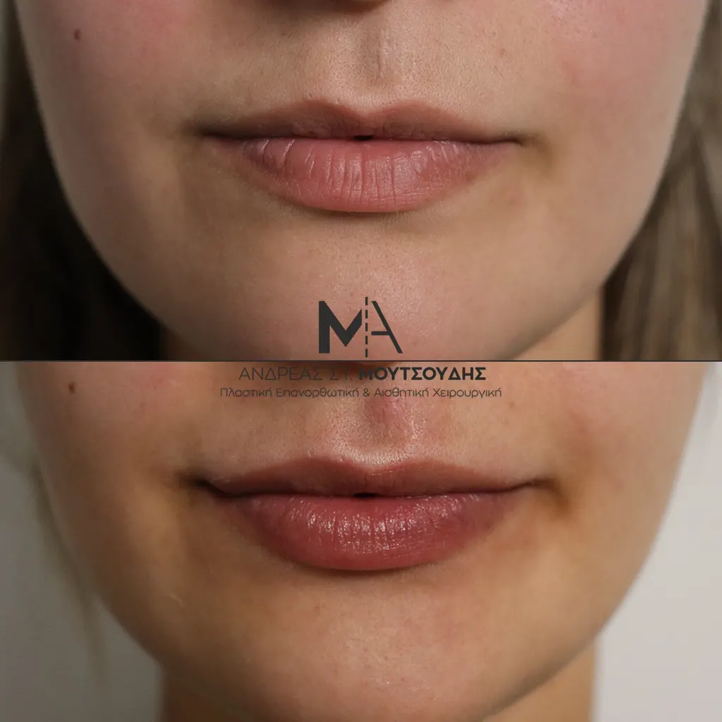 Υαλουρονικό Οξύ χείλη φωτογραφίες Πριν και Μετά
