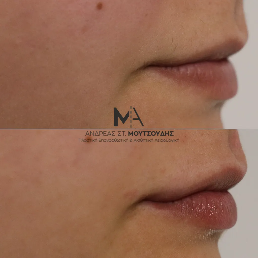 Υαλουρονικό Οξύ χείλη φωτογραφίες Πριν και Μετά
