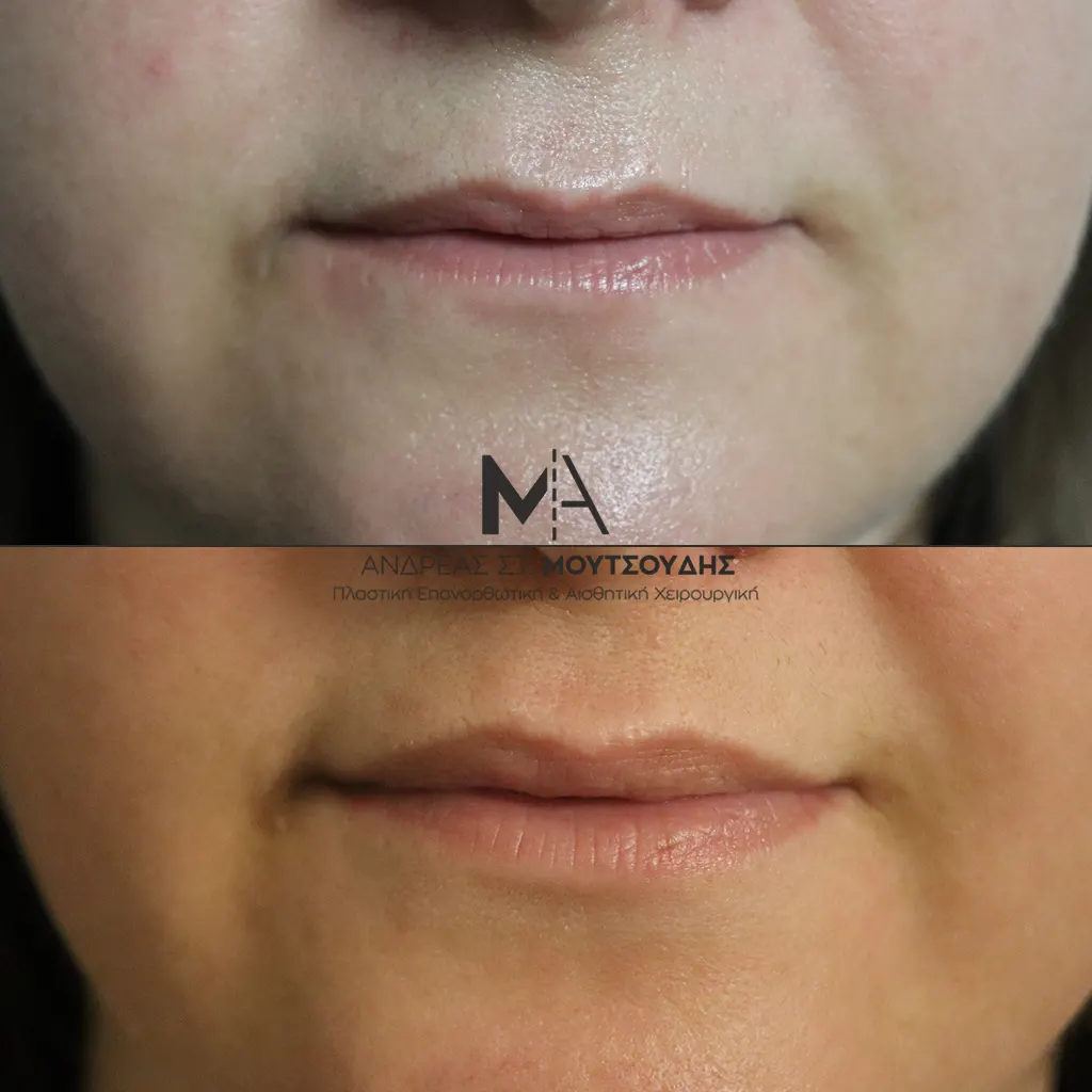 Υαλουρονικό Οξύ χείλη φωτογραφίες Πριν και Μετά