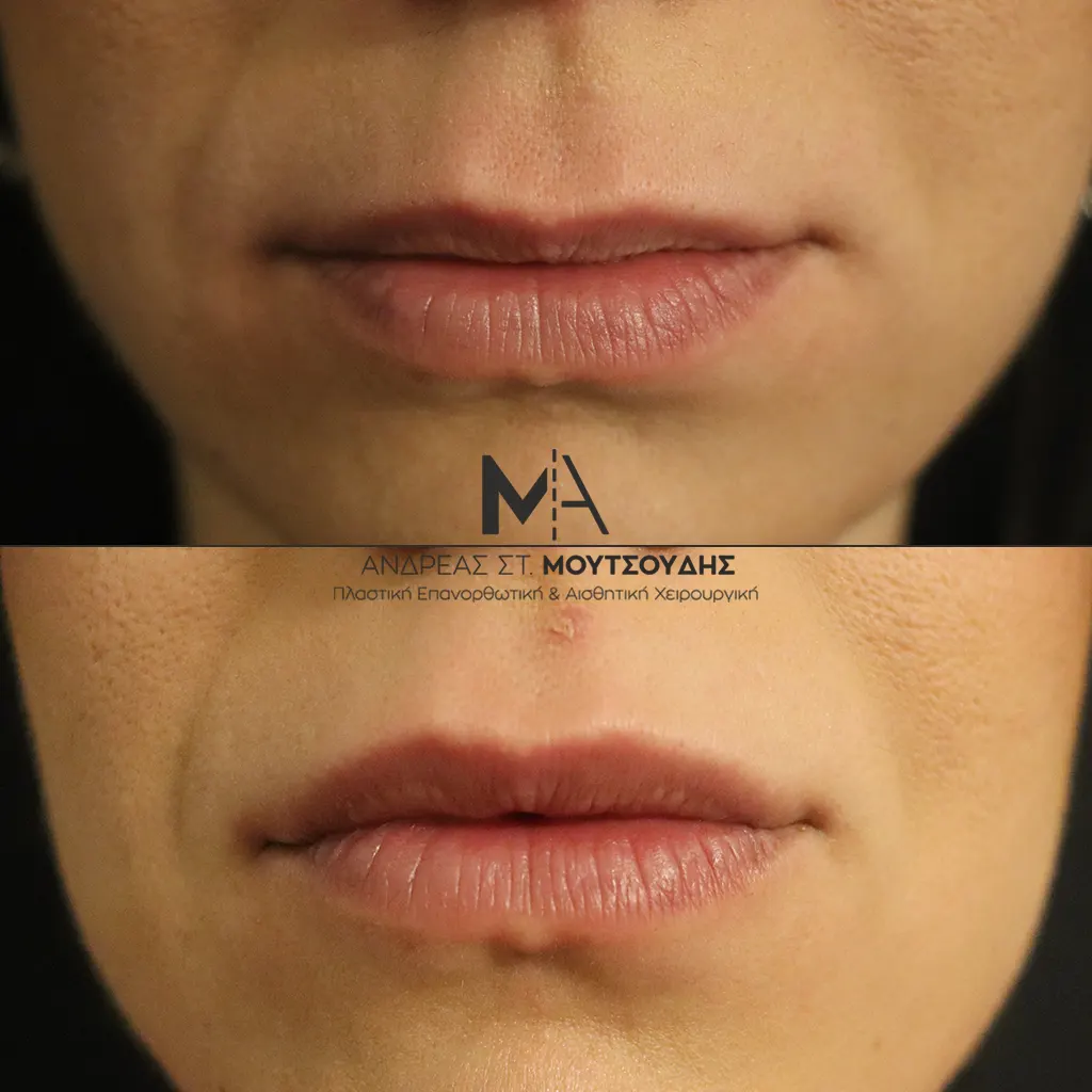 Υαλουρονικό Οξύ χείλη φωτογραφίες Πριν και Μετά