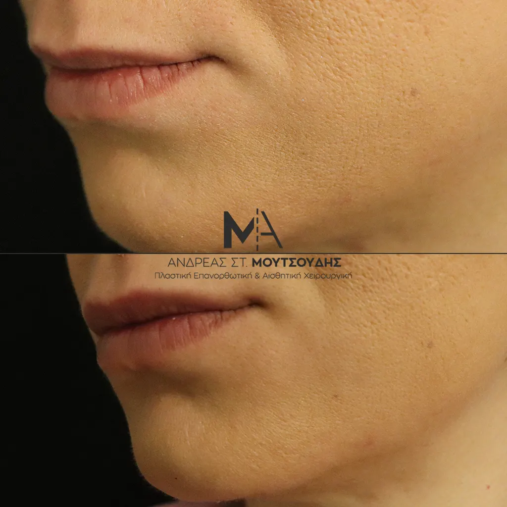 Υαλουρονικό Οξύ χείλη φωτογραφίες Πριν και Μετά