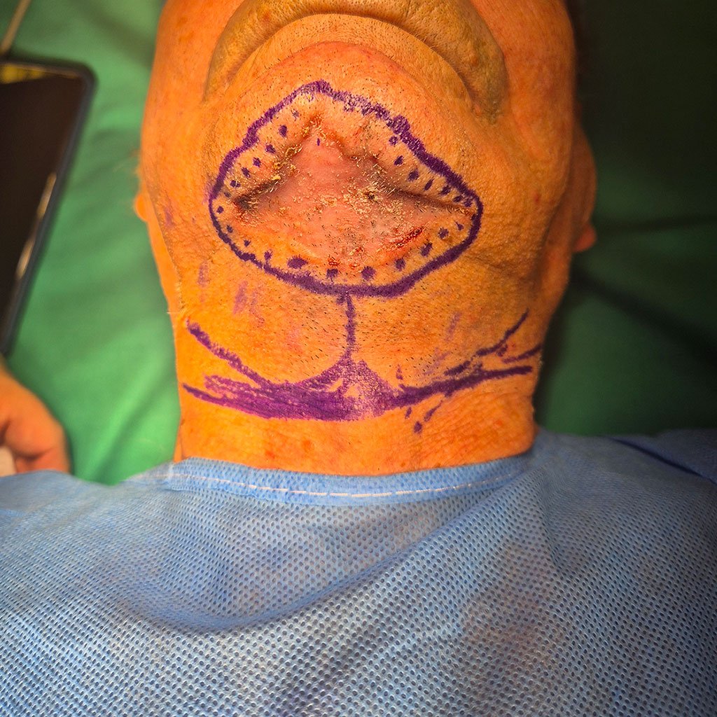 Βασικοκυτταρικό Καρκίνωμα Τραχήλου: Πλήρης Αφαίρεση και Αποκατάσταση με Εξαιρετικό Αποτέλεσμα