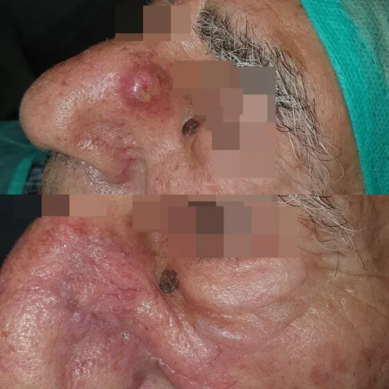 Συνέντευξη του γιατρού Ανδρέα Μουτσούδη στην ηλεκτρονική εφημερίδα cityportal.gr για την πρόληψη του καρκίνου του δέρματος και την έγκαιρη διάγνωσή του.
