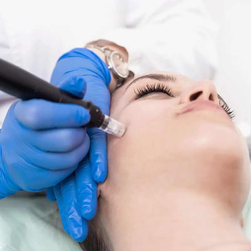 Diamond Microdermabrasion and Skin Preparation