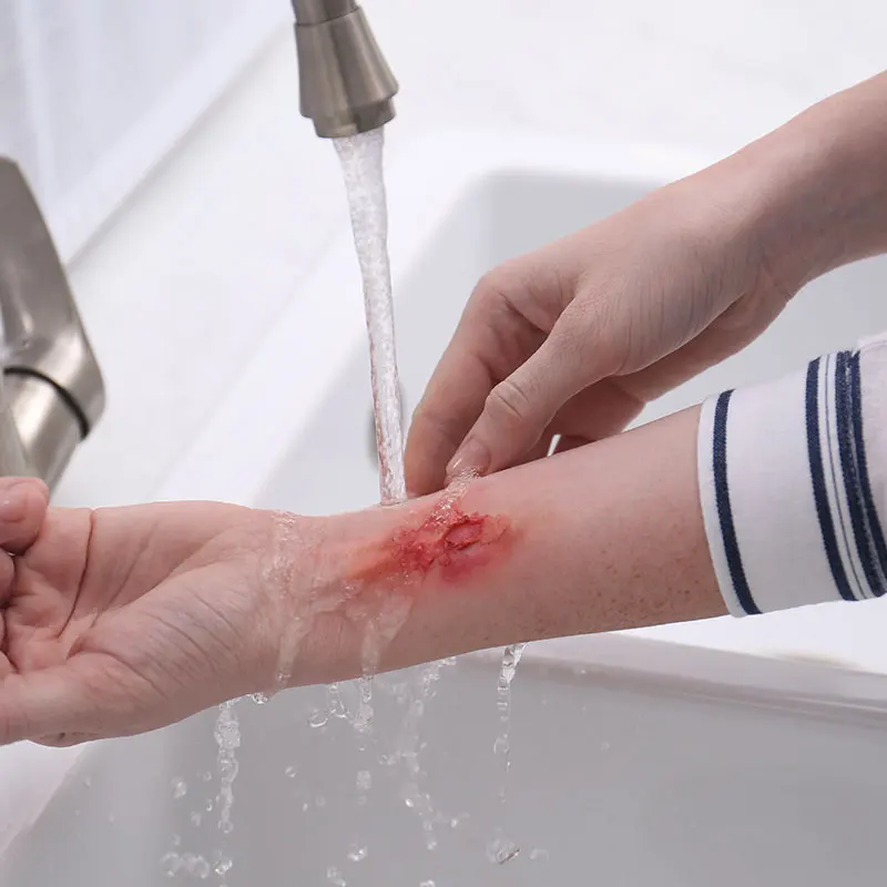 Burn Depth and Immediate First Aid