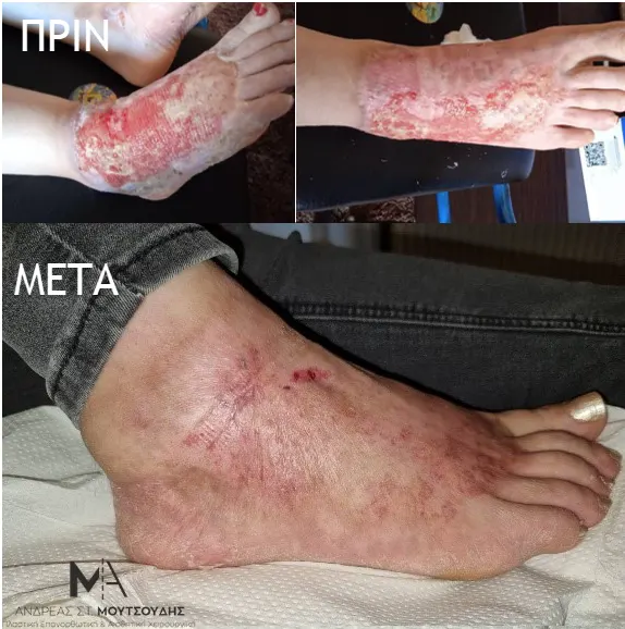 Burn Treatment and Reconstruction