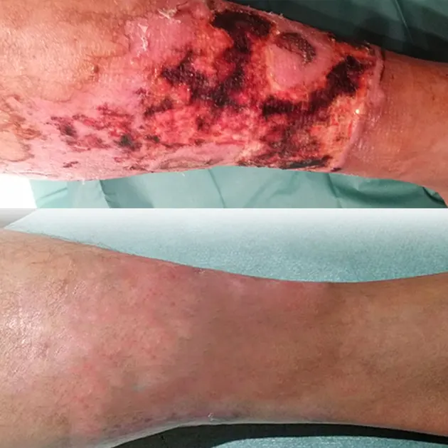 Patient Case: Second-Degree Burn