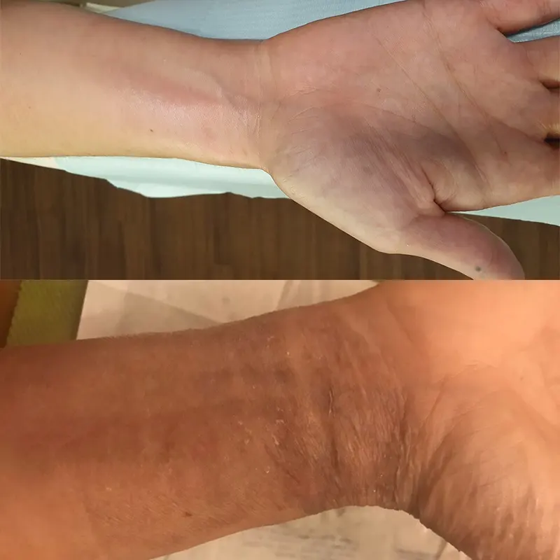 Skin Repair After a First- and Partial Second-Degree Hand Burn