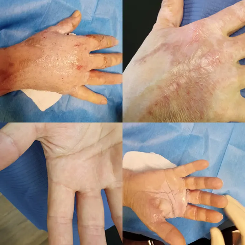 Thermal Burn of the Right Hand