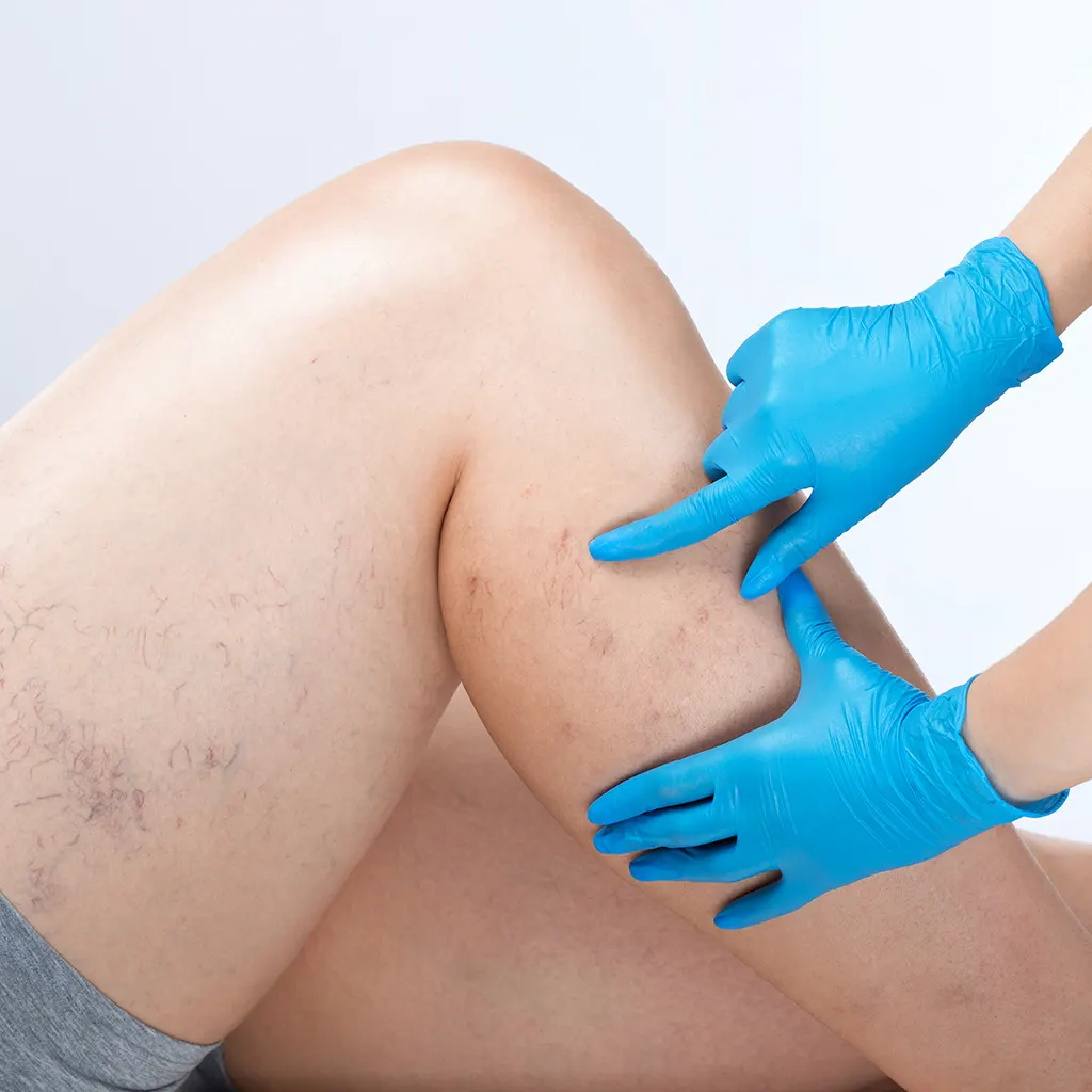 Thread Veins and VEINO 980 nm Diode Laser Treatment