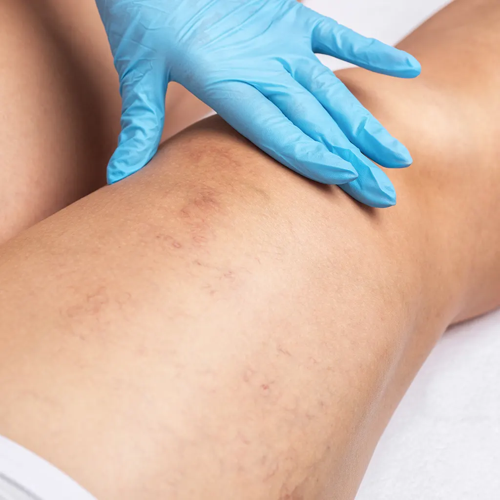 What Is the VEINO 980 nm Vascular Diode Laser?
