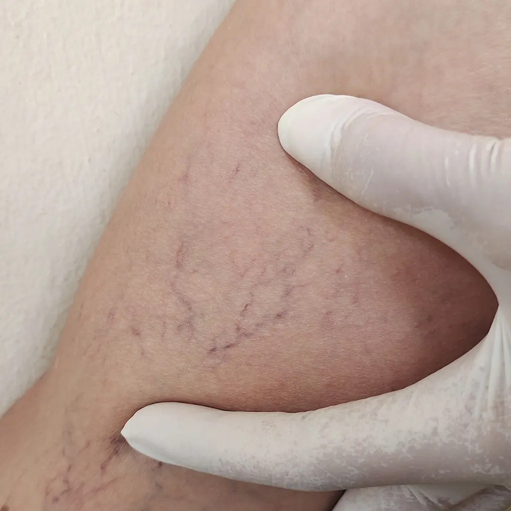 How Does VEINO 980 nm Laser Treatment Work?