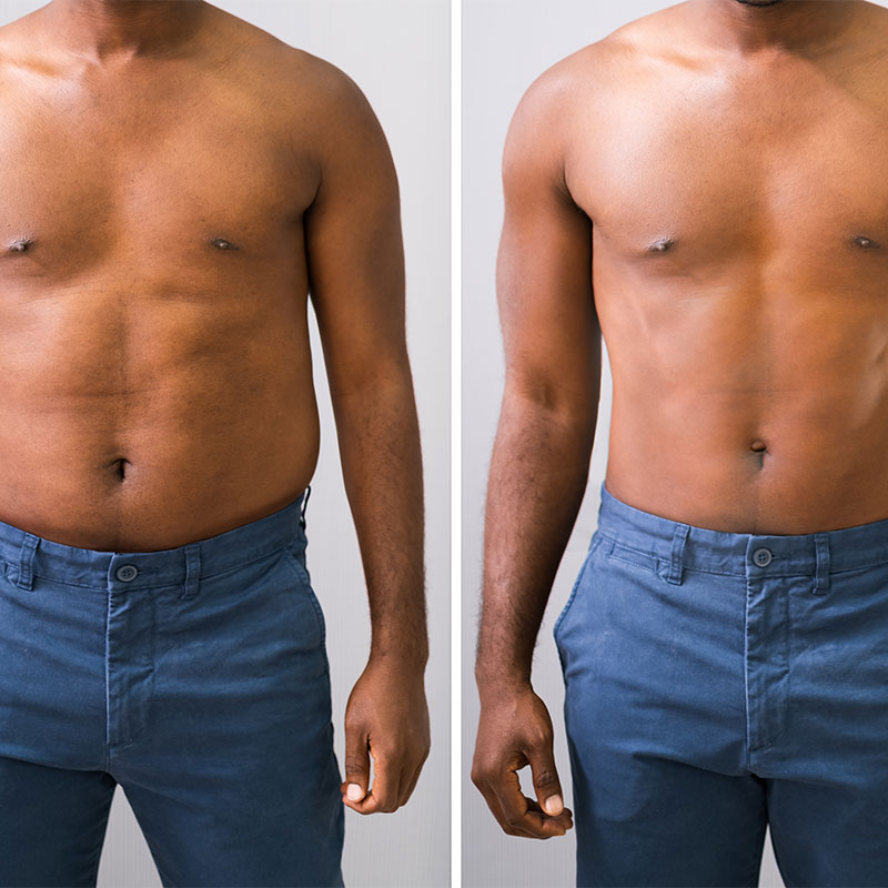 Recovery After Abdominoplasty and Combination with Liposuction