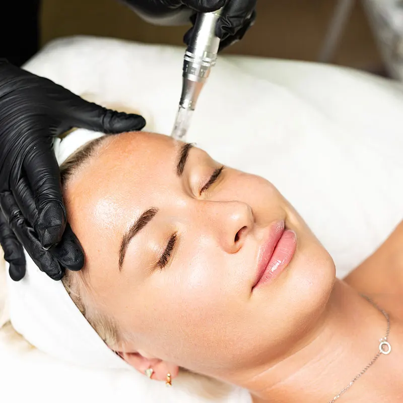 Μεσοθεραπεία Microneedling με DERMAPEN 4, Αποτελεί την GOLD STANDARD τεχνική ανάπλασης της επιδερμίδας και antiaging