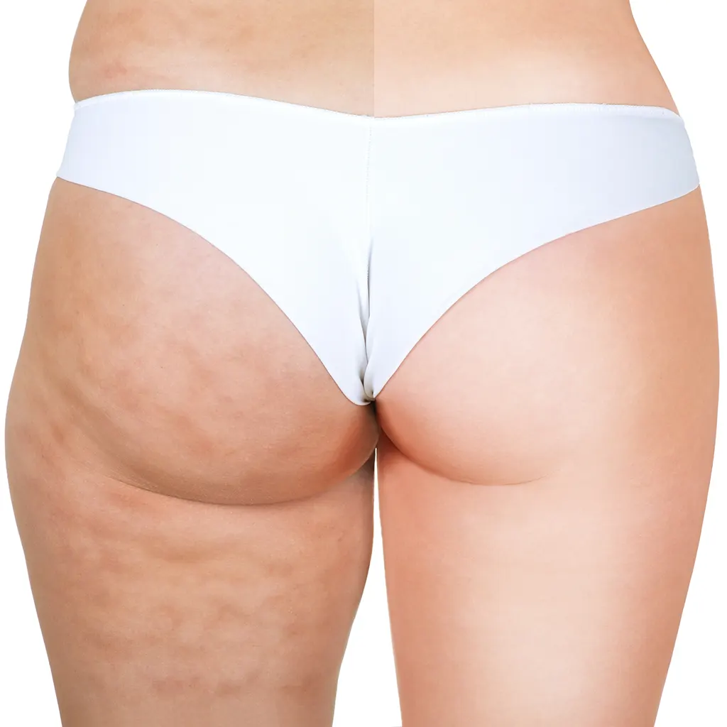 What Is Body Mesotherapy?