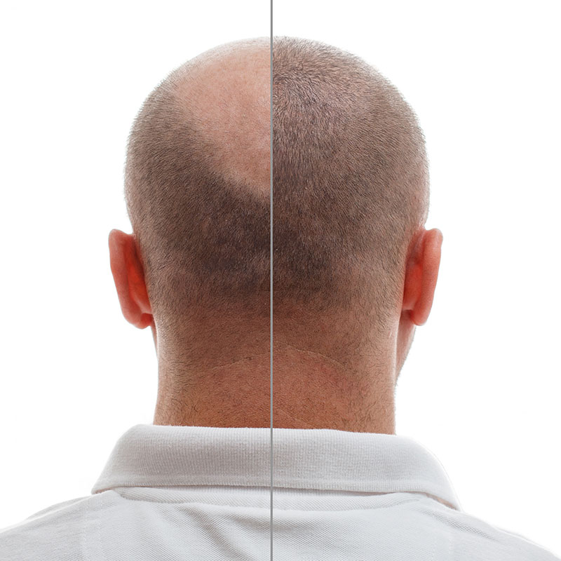 Factors in Planning FUE Hair Transplantation