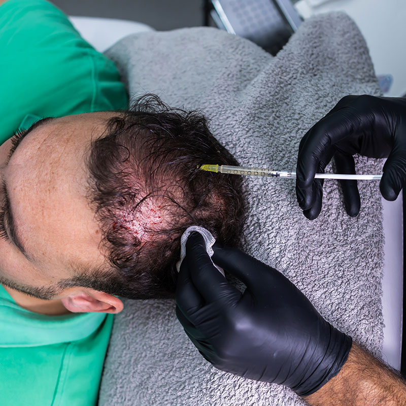 Key Parameters of FUE Hair Transplantation