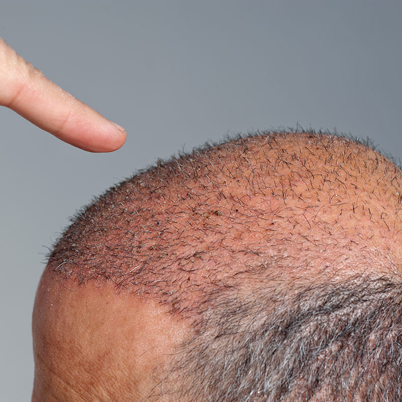 Follicular Unit Placement Techniques and the Use of an Implanter