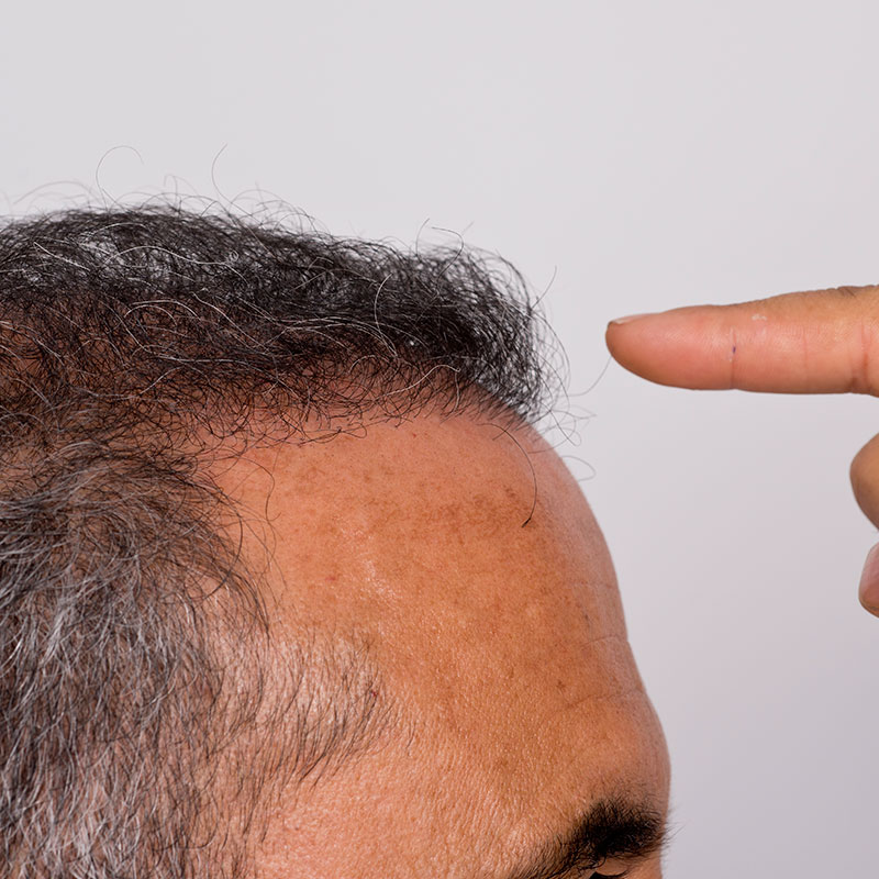 Characteristics of FUE Hair Transplantation