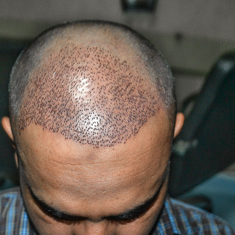 Number of Grafts and Sessions