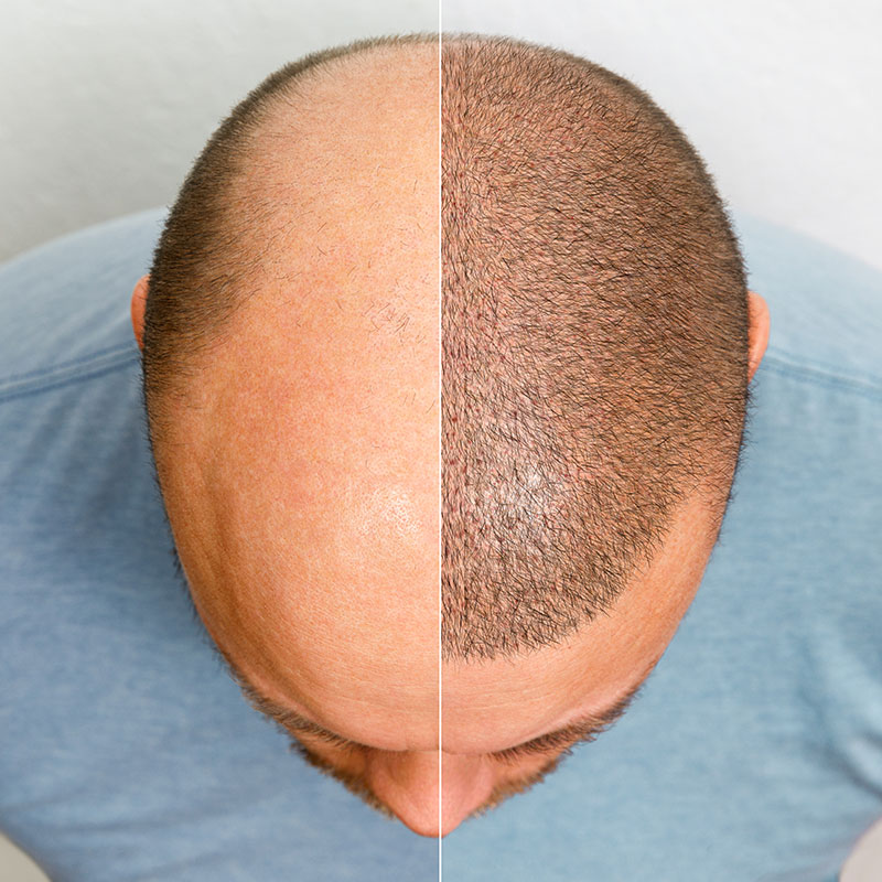 FUE Hair Transplantation in Other Areas