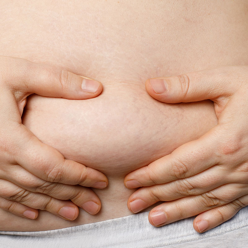 Dermapen 4 Microneedling for Stretch Marks