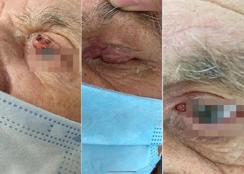 Ακανθοκυτταρικό Καρκίνωμα Ρινός