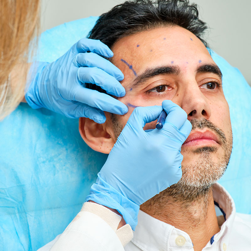 Male Blepharoplasty: Upper and Lower Eyelids