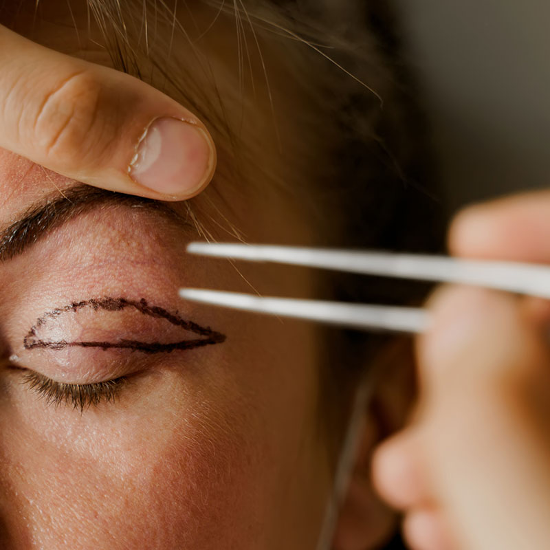 What Blepharoplasty Addresses and How It Is Performed