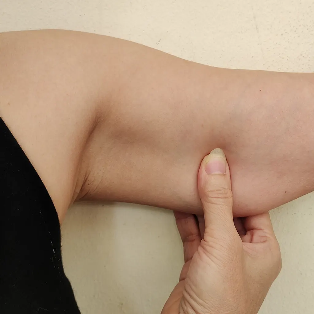 Upper-Arm Skin Laxity