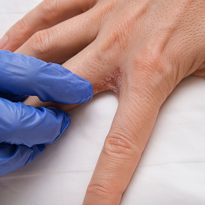 Tumours of the Hand