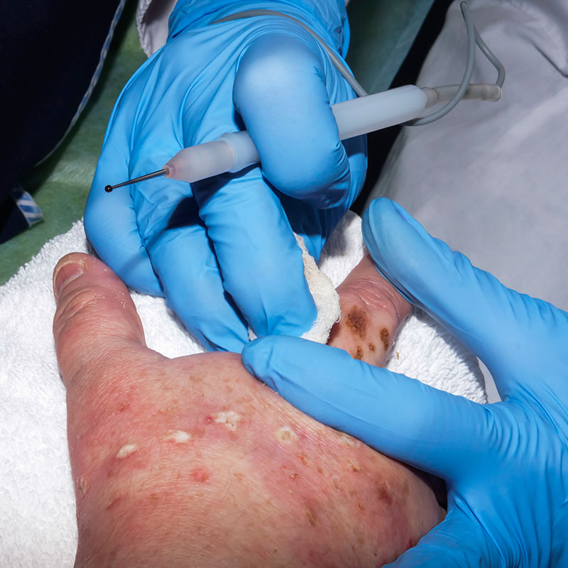 Giant Cell and Nerve-Sheath Tumours